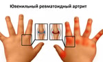 Педиатр из Узбекистана рассказал, как распознать ювенильный ревматоидный артрит у детей и как его лечить