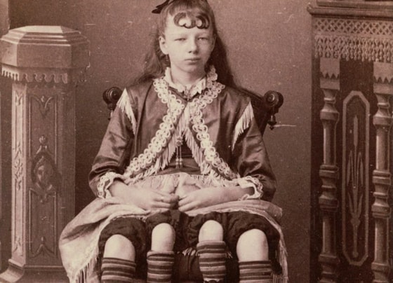 Jozefina Mirtl Korbin - ikki tos suyagi va ikkinchi tos suyagida to'rtta oyoq bilan tug'ilgan amerikalik qiz.