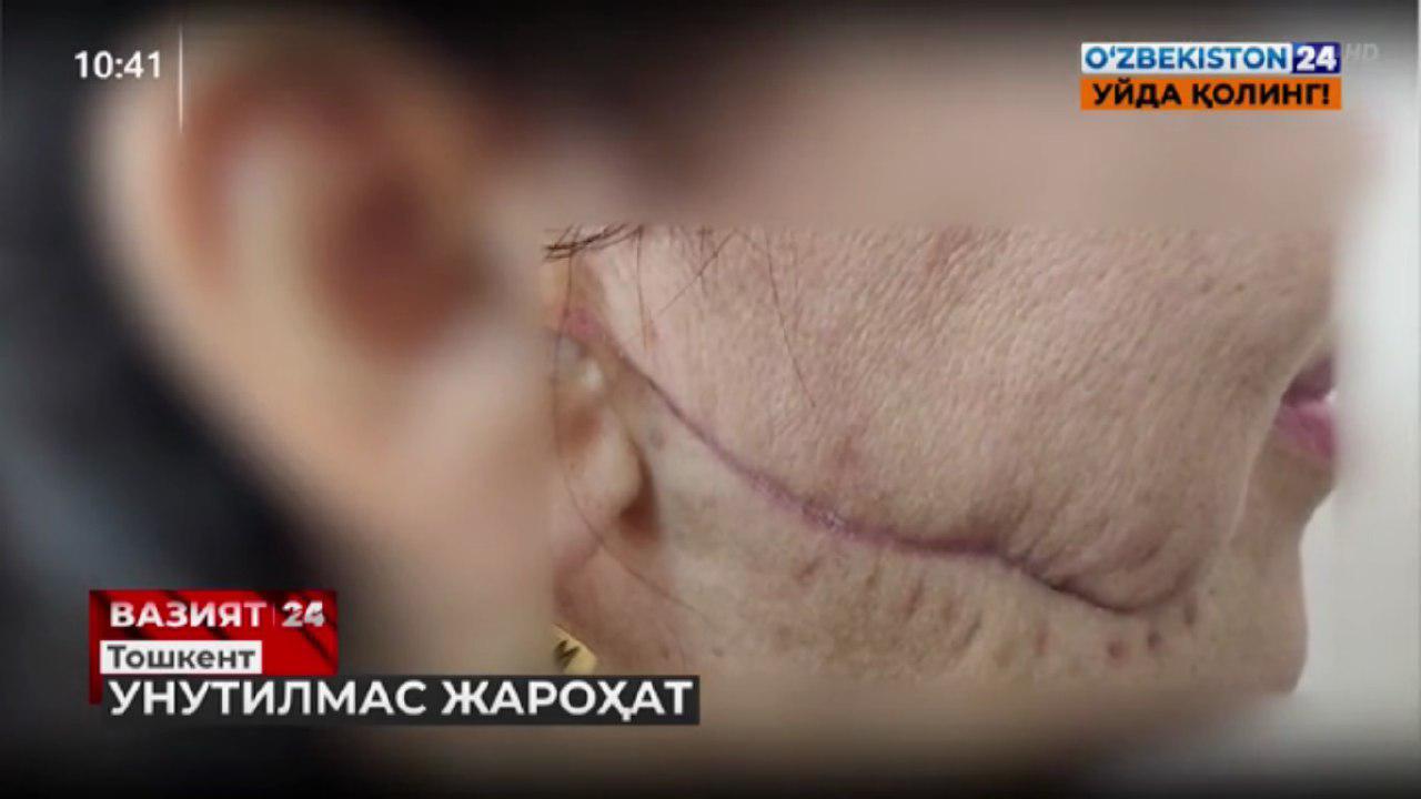 В Ташкенте мужчина порезал лицо и руку своей жены лезвием во время ссоры и получил срок