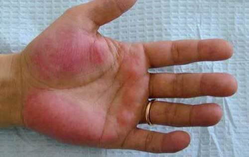 Узбекский терапевт рассказала, симптомом какой болезни может быть покраснение рук