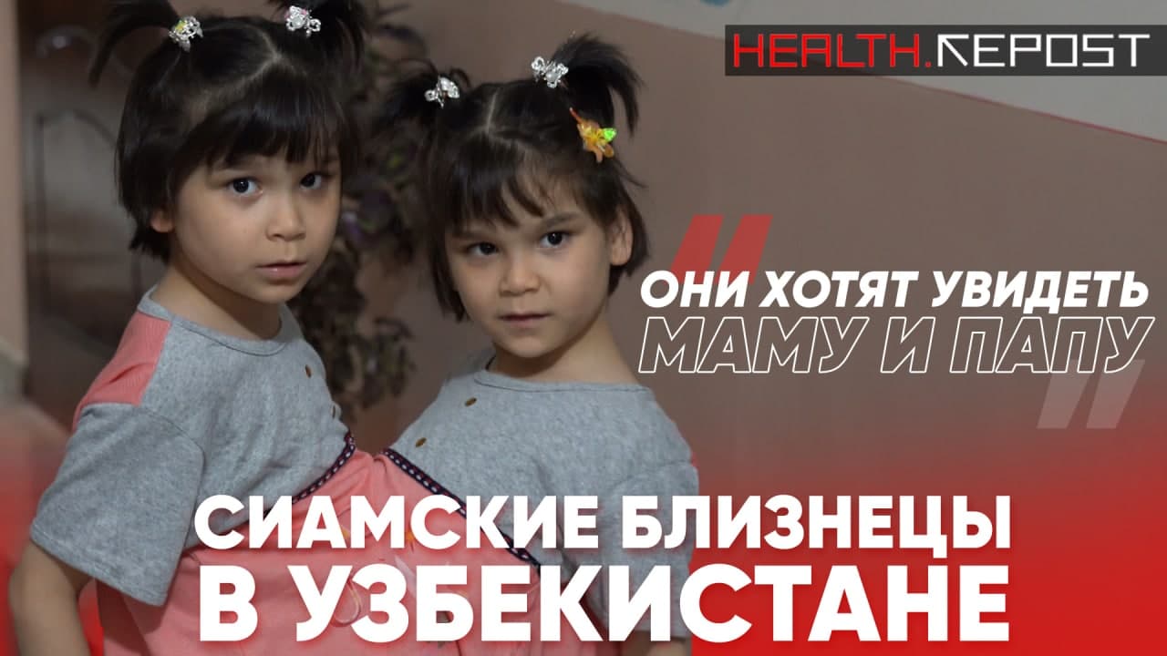 Сиамские близнецы в Узбекистане: как живут неразлучные сестры