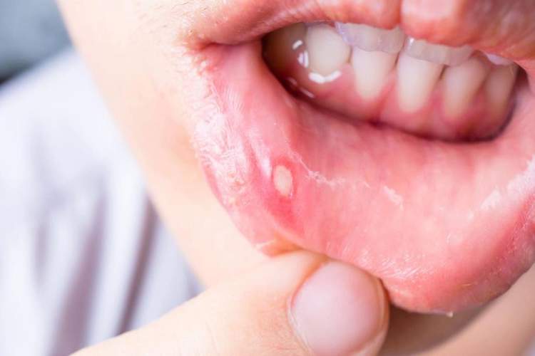 Как лечить язвы, которые появляются во рту? Когда стоит обратиться к врачу?