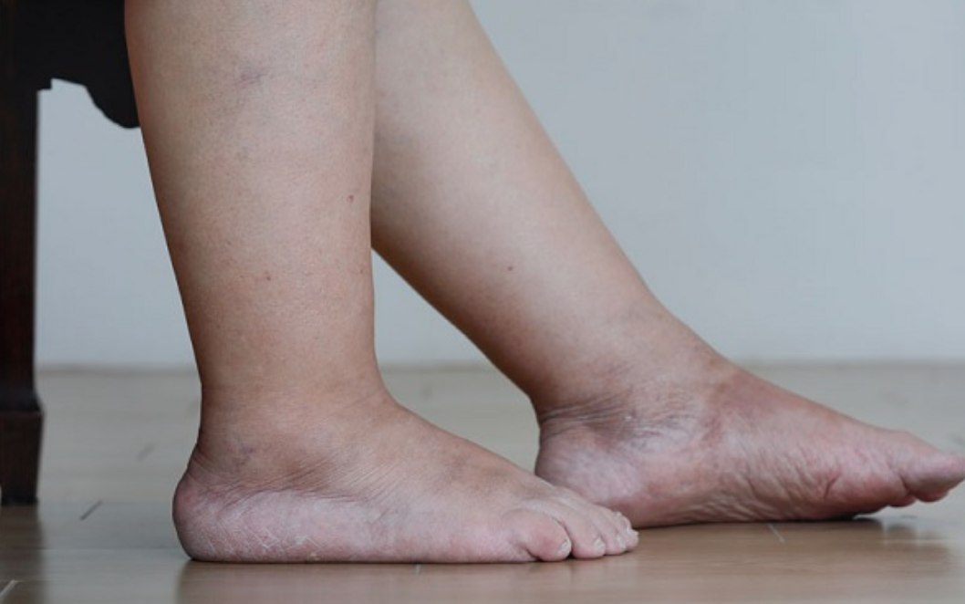 В чем опасность отека ног — мнение терапевта