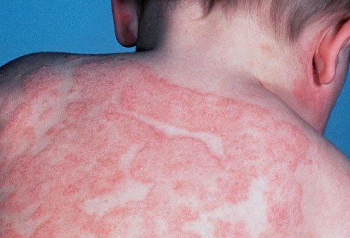 Диагностика и лечение атопического дерматита у детей