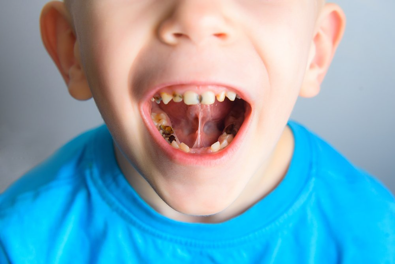 Как мы вылечили трехлетнему ребенку 11 зубов с седацией