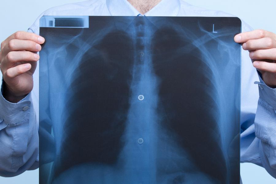 В Узбекистане от пневмонии умер еще один пациент — статистика