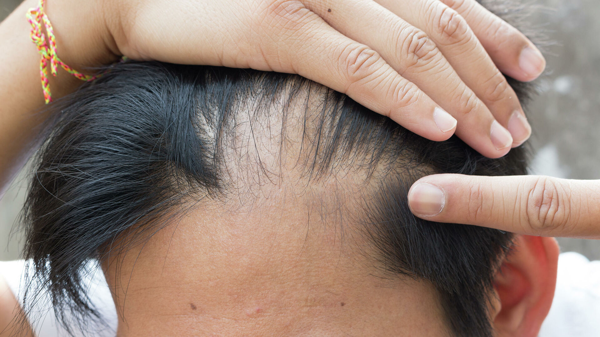 Какие продукты помогут с выпадением волос после ковида