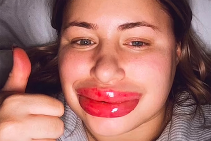 Американка решила накачать губы, а они увеличились в восемь раз из-за аллергии 