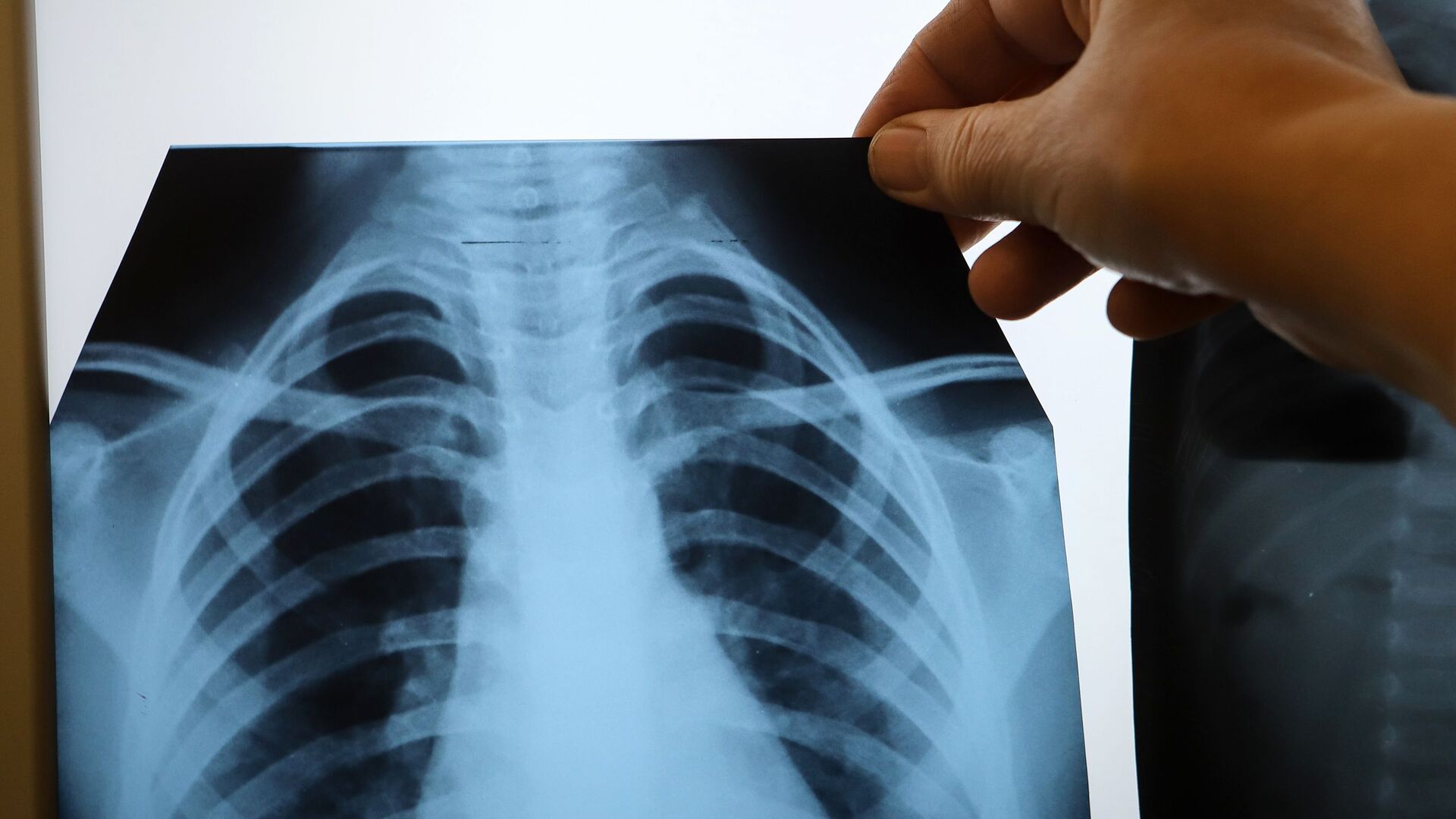 Узбекистан направит почти $60 млн на борьбу с туберкулезом 