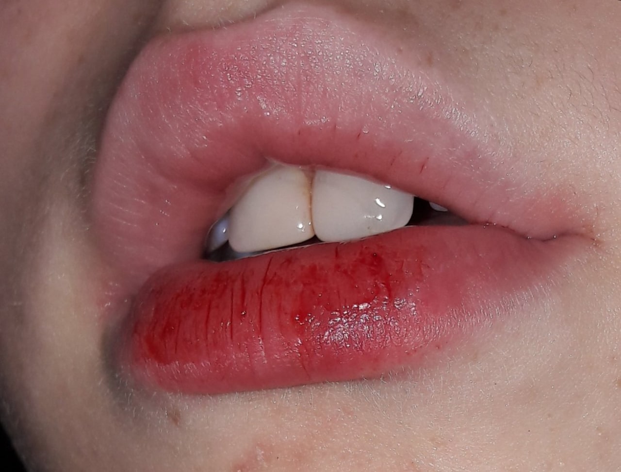 Почему люди кусают губы и щеки | Купрум