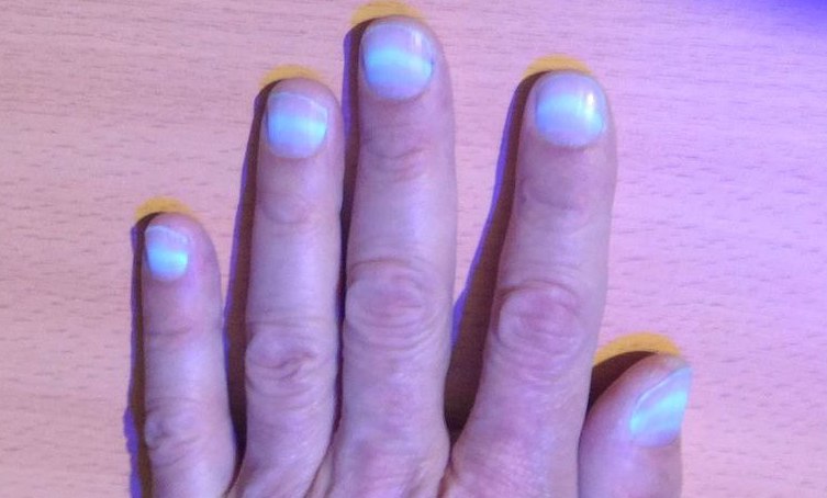 Узбекский терапевт рассказала, почему после COVID-19 светятся ногти