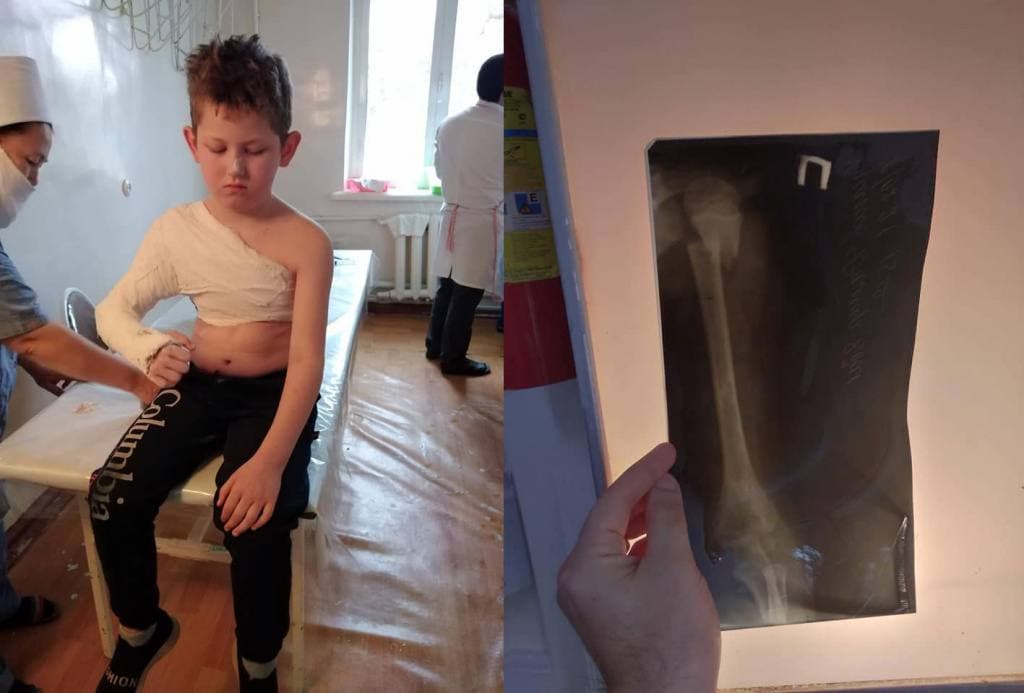 В Ташкенте восьмилетнему ребенку сломали руку на детской площадке 
