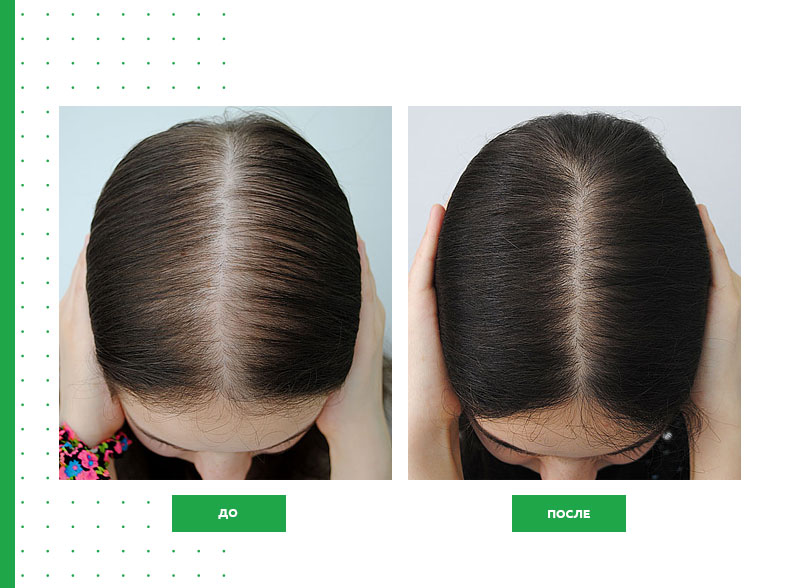 Фото до и после лечения волос от заболеваний