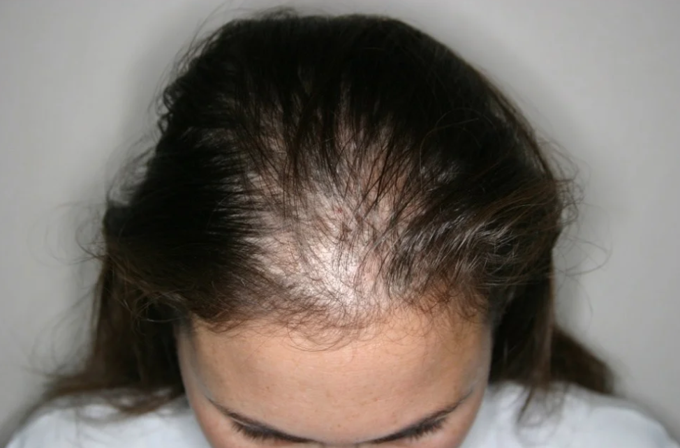Узбекский терапевт рассказала, должны ли волосы выпадать каждый день или это патология