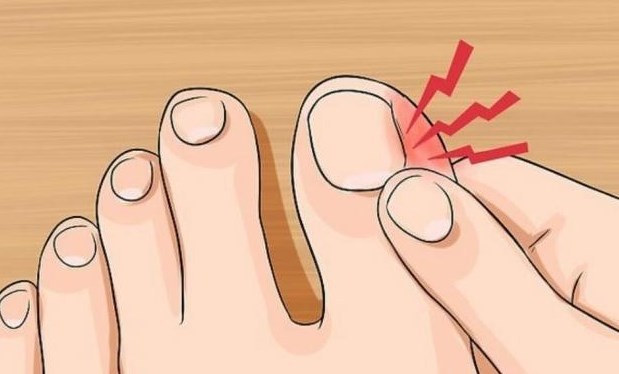 Как вылечить грибок на ногтях ног - 3 способа