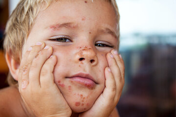 Псориаз на лице у детей фото