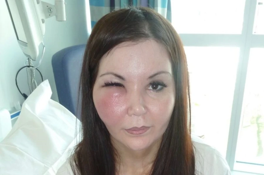 Женщина перенесла множество операций, чтобы восстановить внешность после филлеров