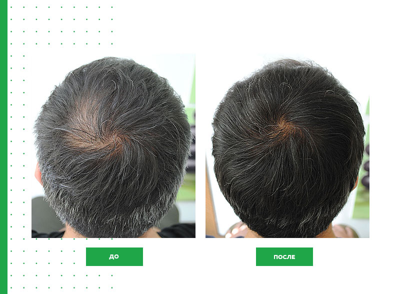 Фото до и после лечения волос от заболеваний