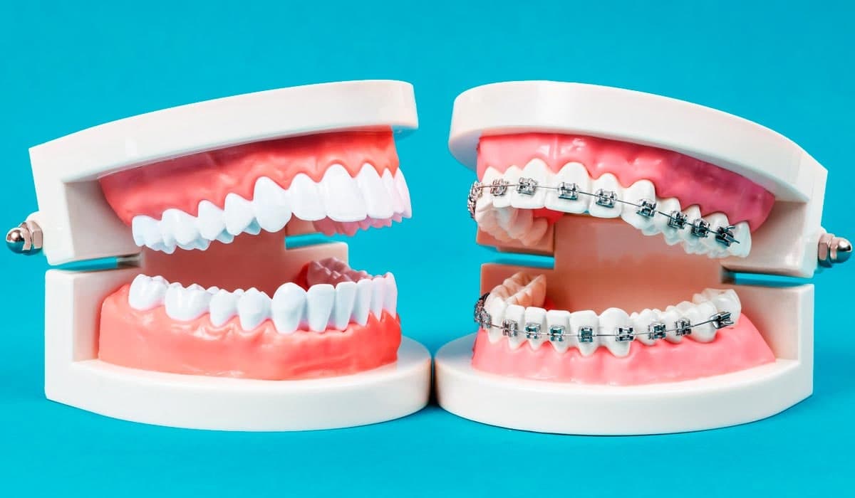 Узнайте, как ортодонты устанавливают брекеты – видео