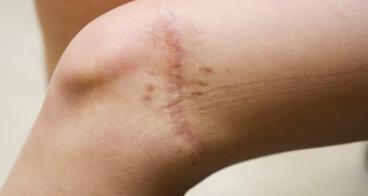 Физиотерапевт из Узбекистана рассказала, в чем главная проблема рубцов на теле