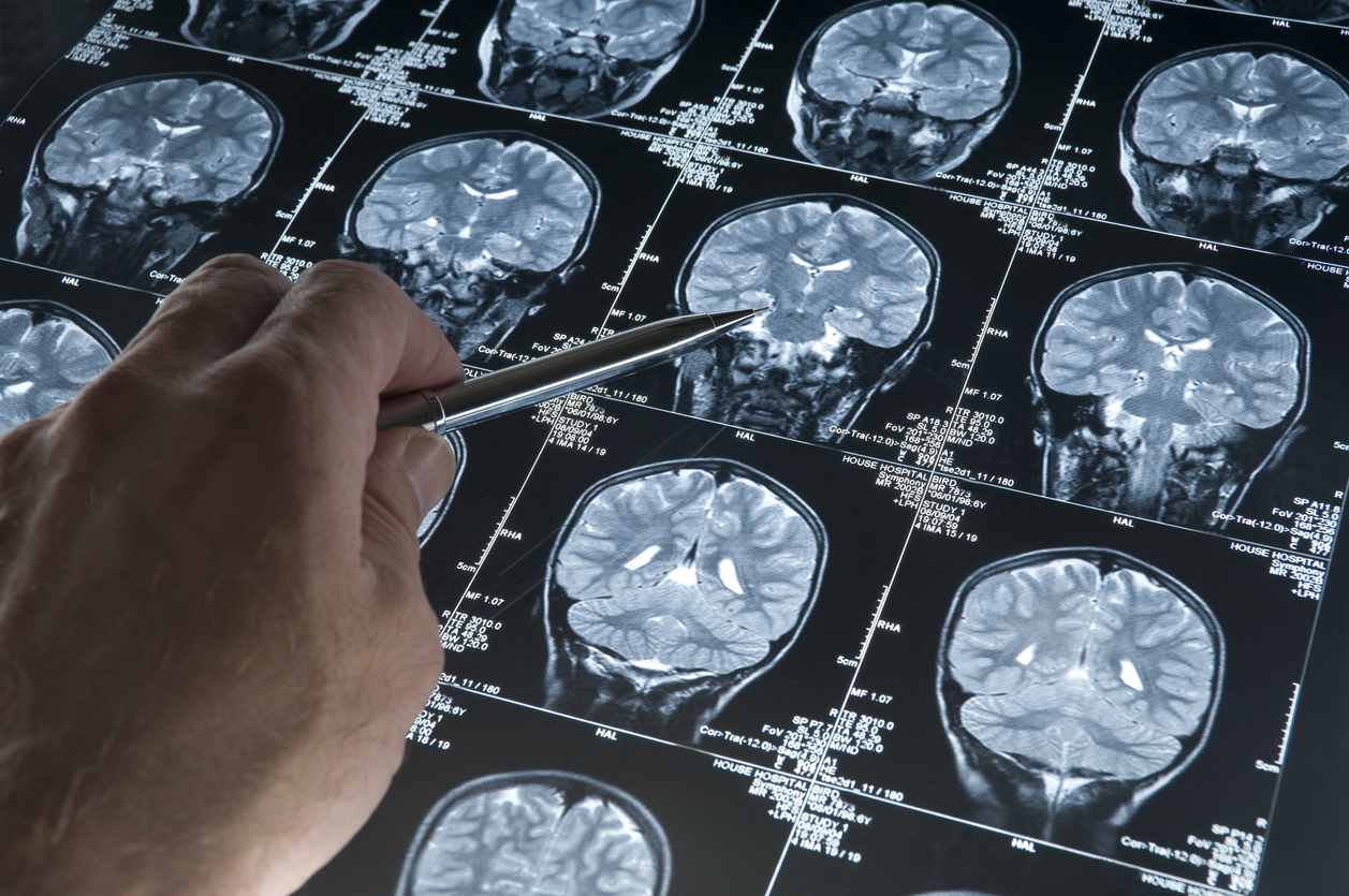Американские ученые нашли новый способ борьбы с болезнью Альцгеймера