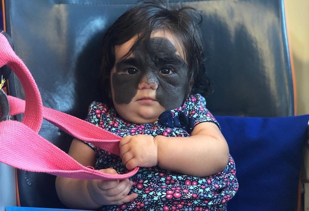 Врачи удалили девочке «маску Бэтмена» с лица. Посмотрите, как она сейчас выглядит — фото