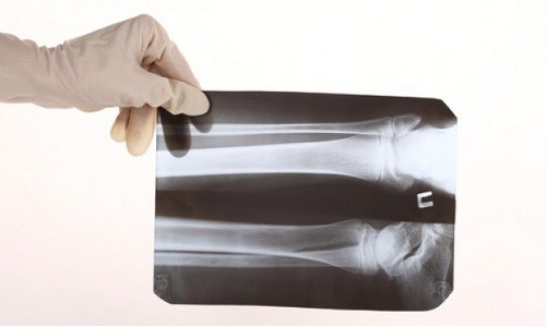 Хирург из Франции пытался продать рентген жертвы теракта как NFT
