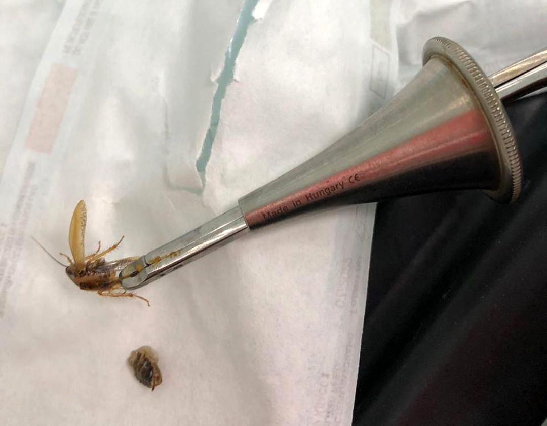 Огромный таракан спрятался в ухе мужчины — пациента госпитализировали с жуткой болью