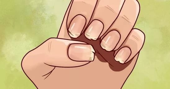 О чем могут говорить слоящиеся ногти и что с ними делать?