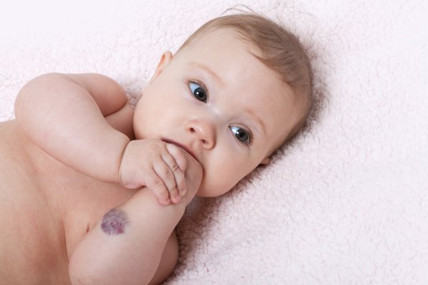Гемангиома у новорожденных: причина и лечение