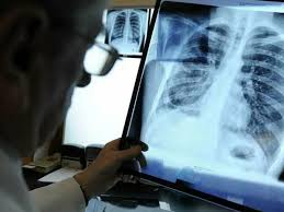 Узбекистанцы стали меньше умирать от туберкулеза  