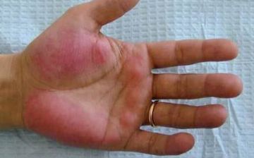 Узбекский терапевт рассказала, симптомом какой болезни может быть покраснение рук