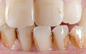 Узбекский стоматолог рассказал, как избавиться от зубного налета