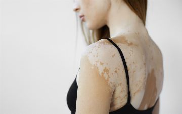 Что такое меланин и от чего зависит пигментация кожи