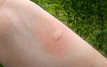 Почему чешется место после укуса комара?