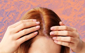 Что делать с псориазом на коже головы: лечение, рекомендованное дерматологами