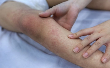 ВОЗ: Число заболевших лихорадкой денге в мире превысило 5 млн