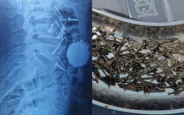 В Самарканде мужчина проглотил около 200 гр гвоздей и саморезов