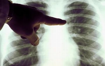 В Узбекистане еще три пациента умерли от пневмонии