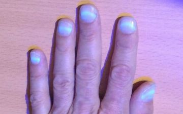Узбекский терапевт рассказала, почему после COVID-19 светятся ногти