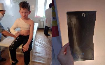 В Ташкенте восьмилетнему ребенку сломали руку на детской площадке 