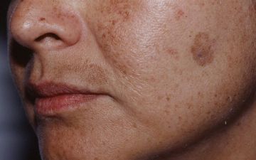 Какие скрытые заболевания можно определить по состоянию кожи?