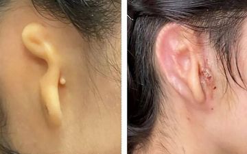 Врачи пересадили девушке ухо, напечатанное на 3D-принтере