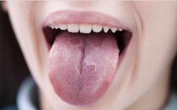 Медики сообщили, что пятна на языке смертельно опасны
