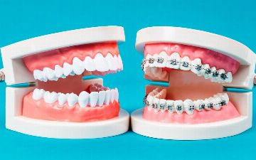 Узнайте, как ортодонты устанавливают брекеты – видео