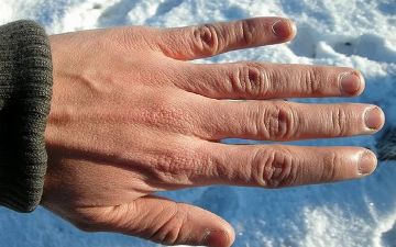 Ученые создали крем, который не дает рукам замерзнуть