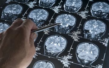 Американские ученые нашли новый способ борьбы с болезнью Альцгеймера