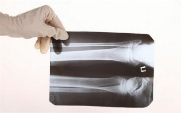 Хирург из Франции пытался продать рентген жертвы теракта как NFT