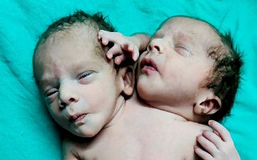 В Индии родился ребенок с двумя головами, двумя сердцами и тремя руками — фото