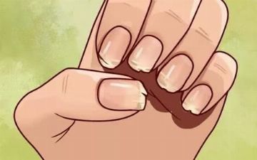 О чем могут говорить слоящиеся ногти и что с ними делать?